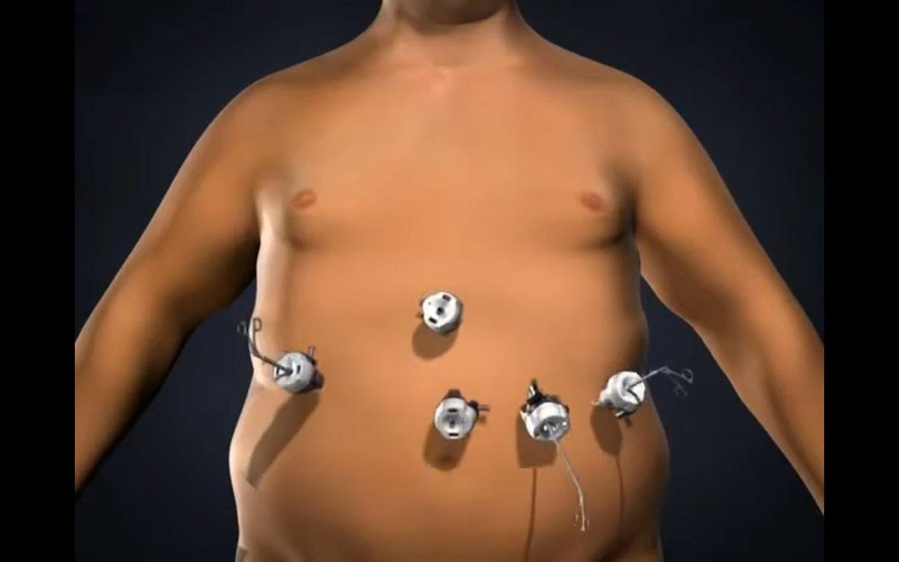 Mide katlama ameliyatı nedir ve mide katlama ameliyatı nasıl yapılır sürecini gösteren cerrahi görsel