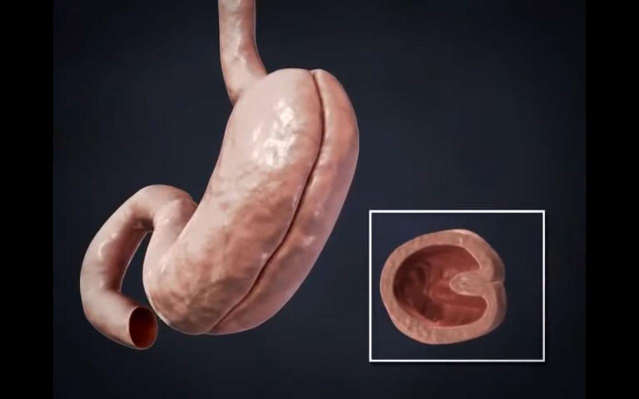 Mide katlama ameliyatı sırasında midenin katlanarak hacminin küçültülmesini gösteren cerrahi görsel