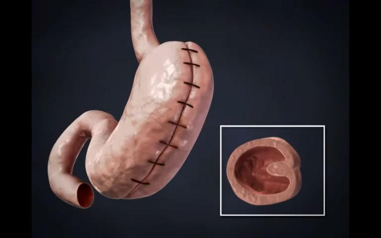 Mide katlama ameliyatının mide hacmini azaltmaya yönelik cerrahi uygulamasını gösteren görsel