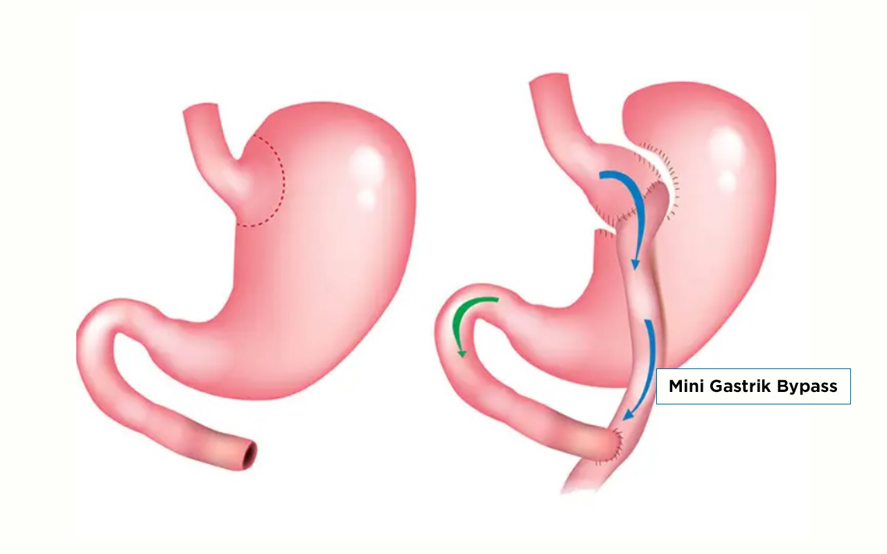 Mini Gastrik Bypass (MGB) Ameliyatı