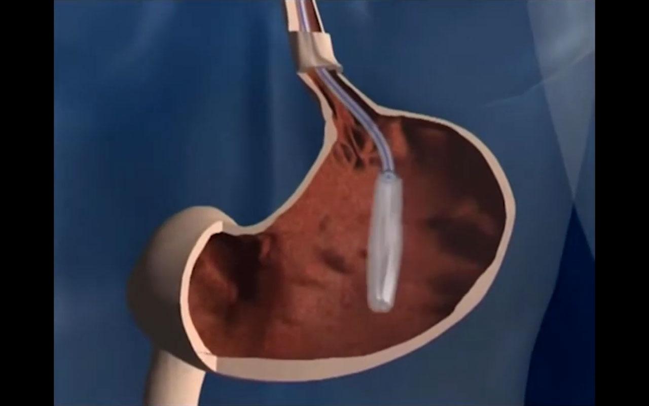 Mide balonu nedir ve mide balonu nasıl yapılır sürecini gösteren mide içi uygulama görseli