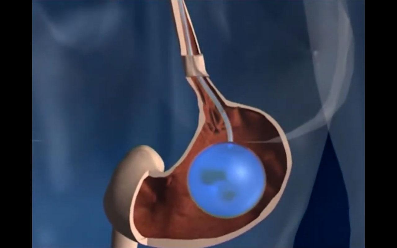 Mide balonu uygulamasının mide içerisindeki yerleşimini ve kullanım amacını gösteren görsel