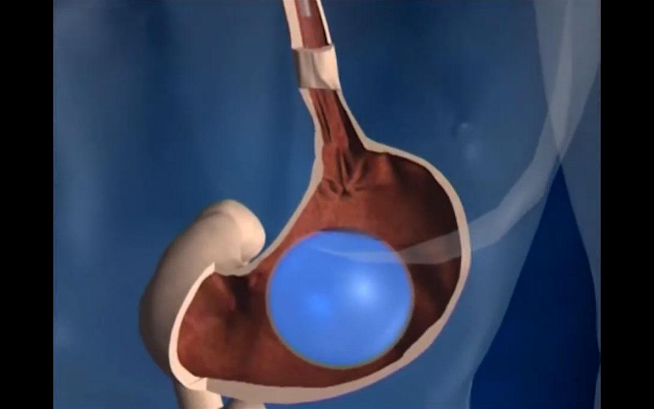 Endoskopik mide balonu uygulamasını ve mide içerisindeki etkisini gösteren görsel