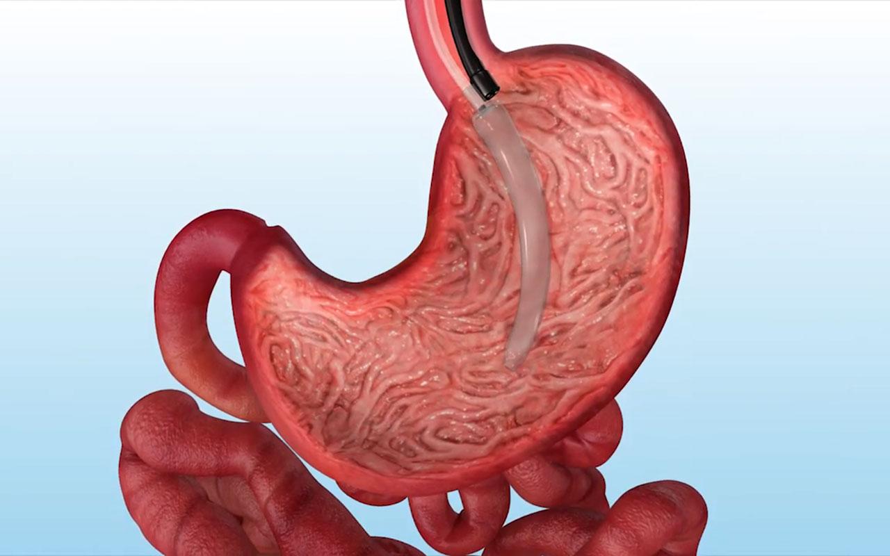 Mide balonu uygulamasının mide hacmi üzerindeki etkisini gösteren görsel
