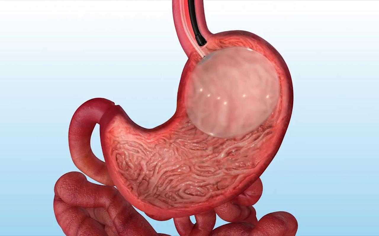 Mide balonu uygulamasının mide içindeki konumunu ve kullanım sürecini gösteren görsel