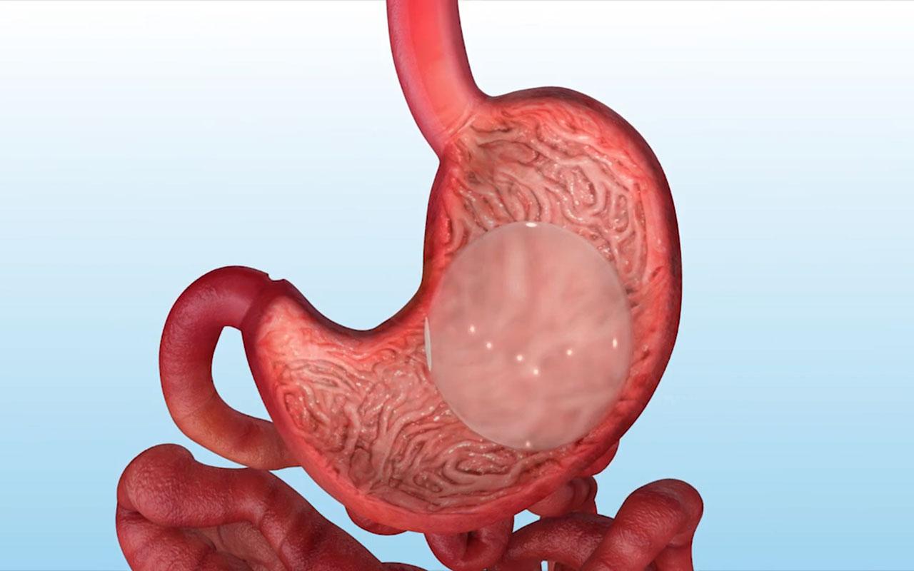 Mide balonu tedavi yönteminin mide içerisindeki uygulanışını gösteren görsel