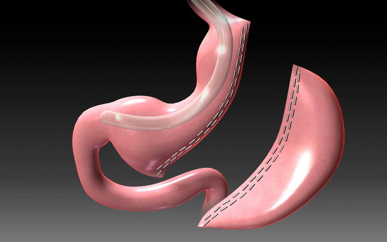 Tüp Mide Ameliyatı Nasıl Yapılır?