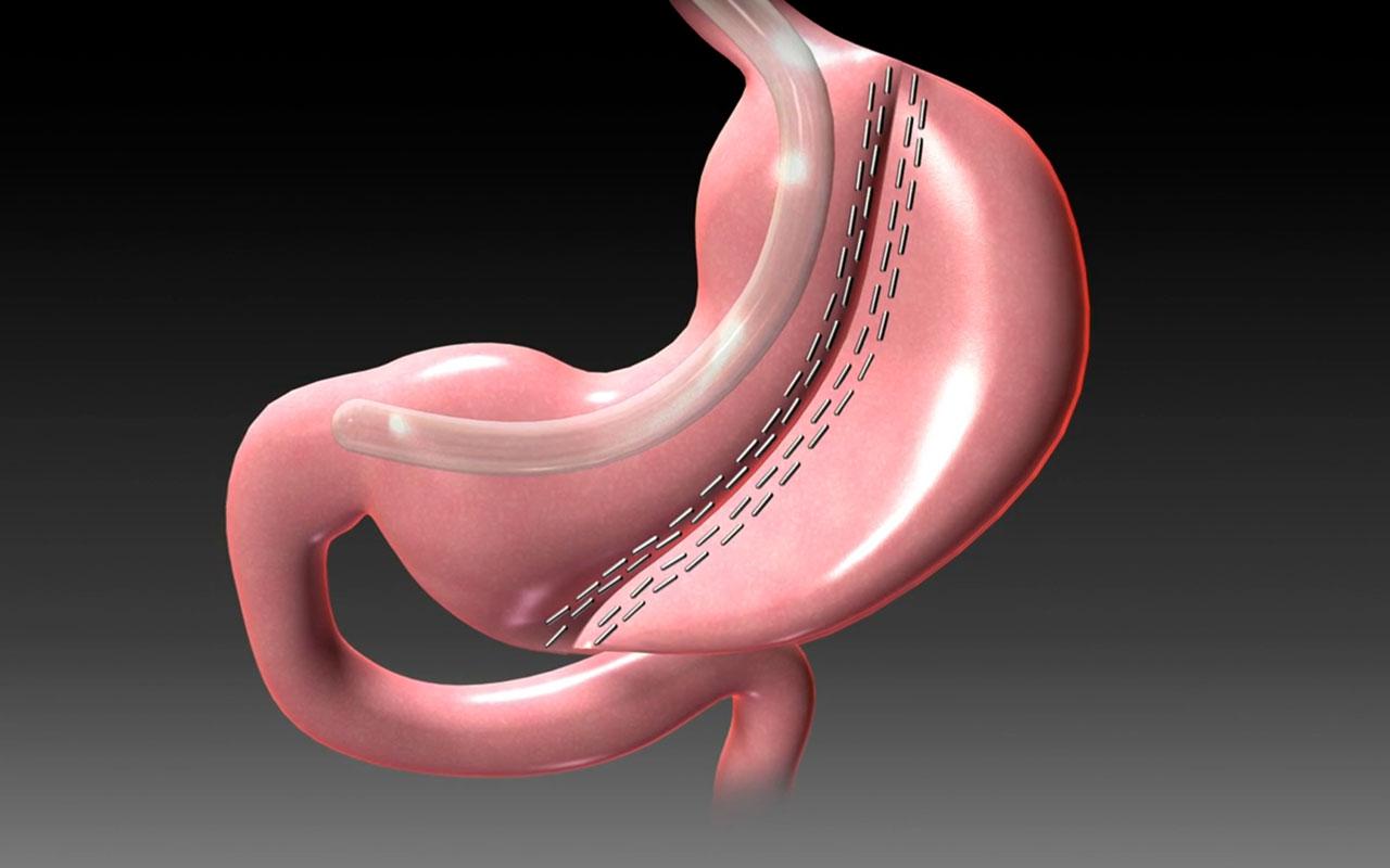 Tüp Mide Ameliyatı Nedir?