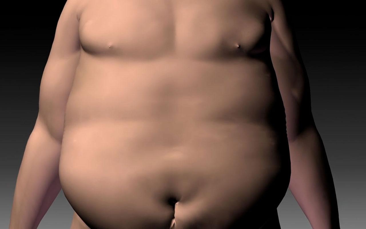 Tüp Mide Ameliyatı Öncesi Vücut Görünümü