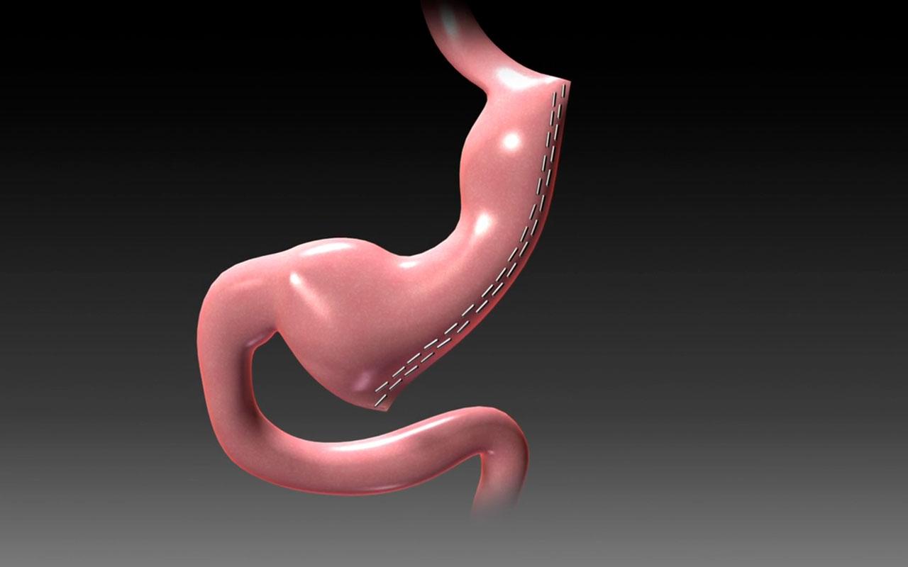 Tüp Mide Ameliyatı Sonrası