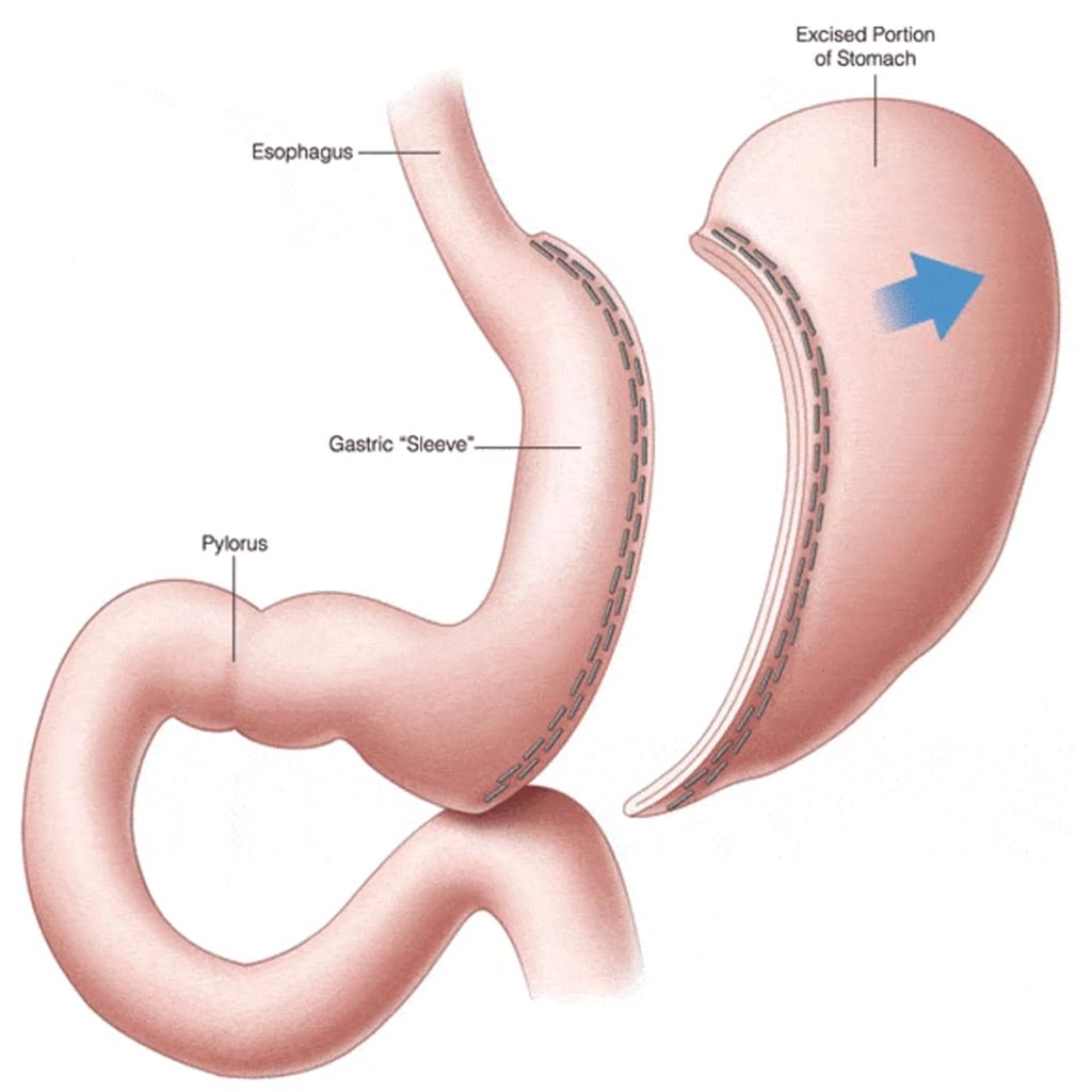 Tüp Mide Ameliyatı