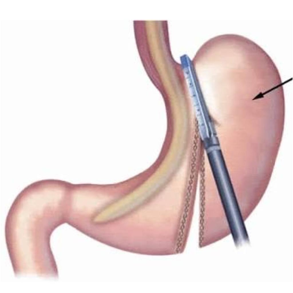 Tüp Mide Ameliyatı