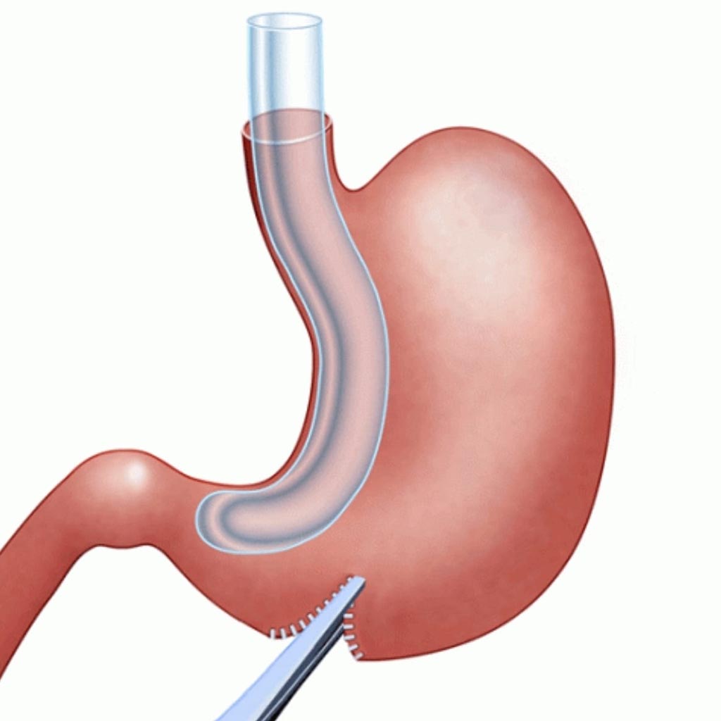 Tüp Mide Ameliyatı