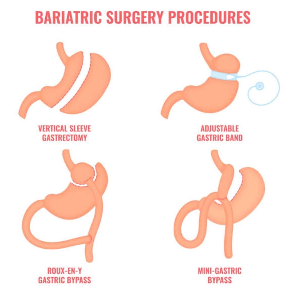 Tüp Mide Ameliyatı