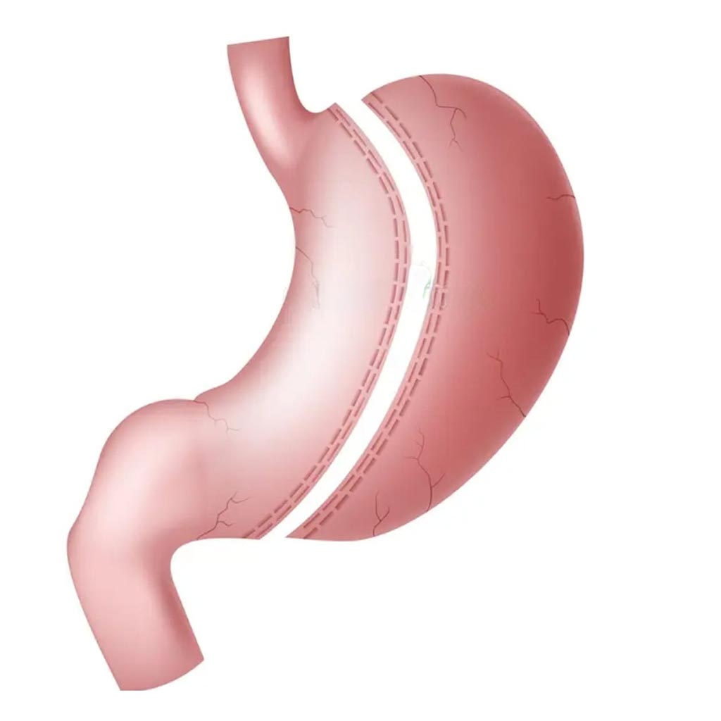 Tüp Mide Ameliyatı