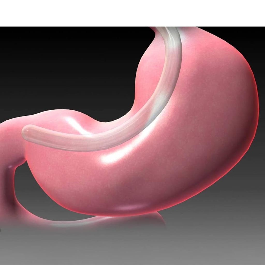 Tüp Mide Ameliyatı